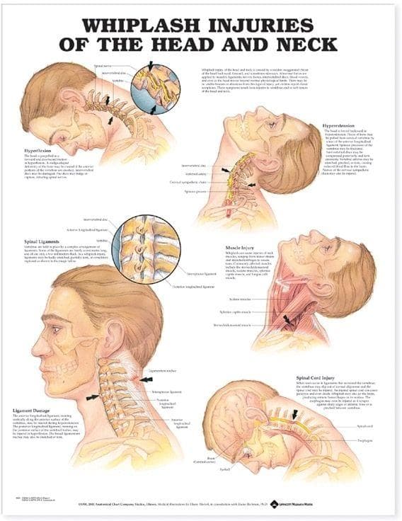 WHIPLASH INJURIES HEAD & NECK PU