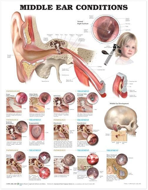 MIDDLE EAR CONDITIONS 2E PAPER CHART